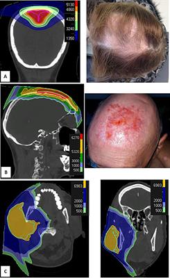 Early Toxicities After High Dose Rate Proton Therapy in Cancer Treatments